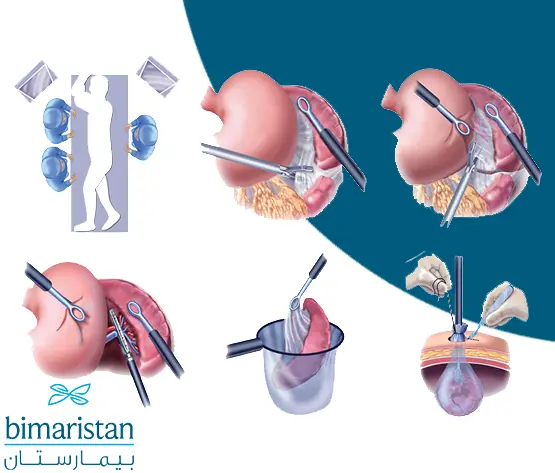 An image showing the steps of the open spleen removal process