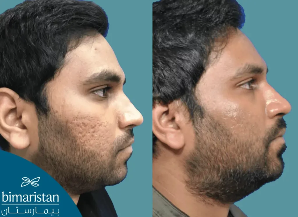 Before and after plasma injection for the face and hair in Turkey