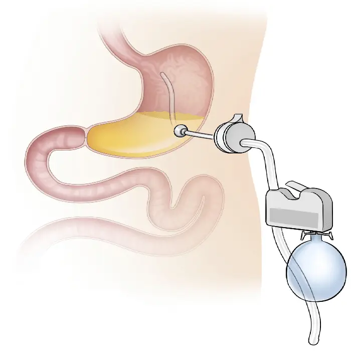 Aspire Assist Gastric Tube