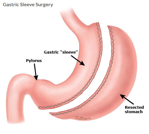 Gastric Sleeve