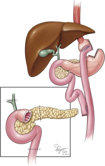 Pancreaticobiliary Bypass