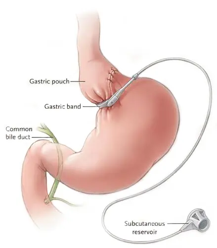 Adjustable Gastric Band Diagram