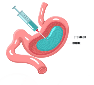 Gastric