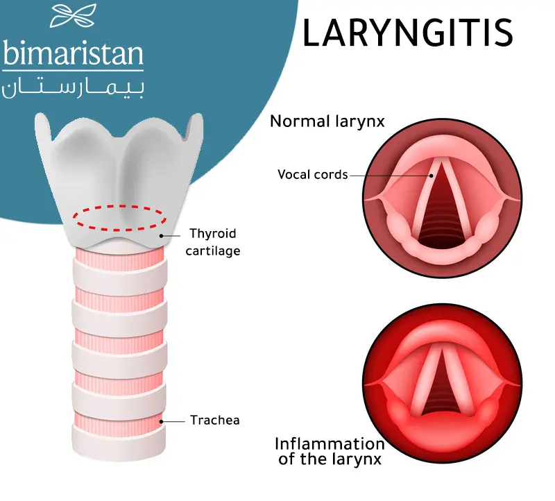 A graphic showing the difference between a normal larynx and an inflamed larynx