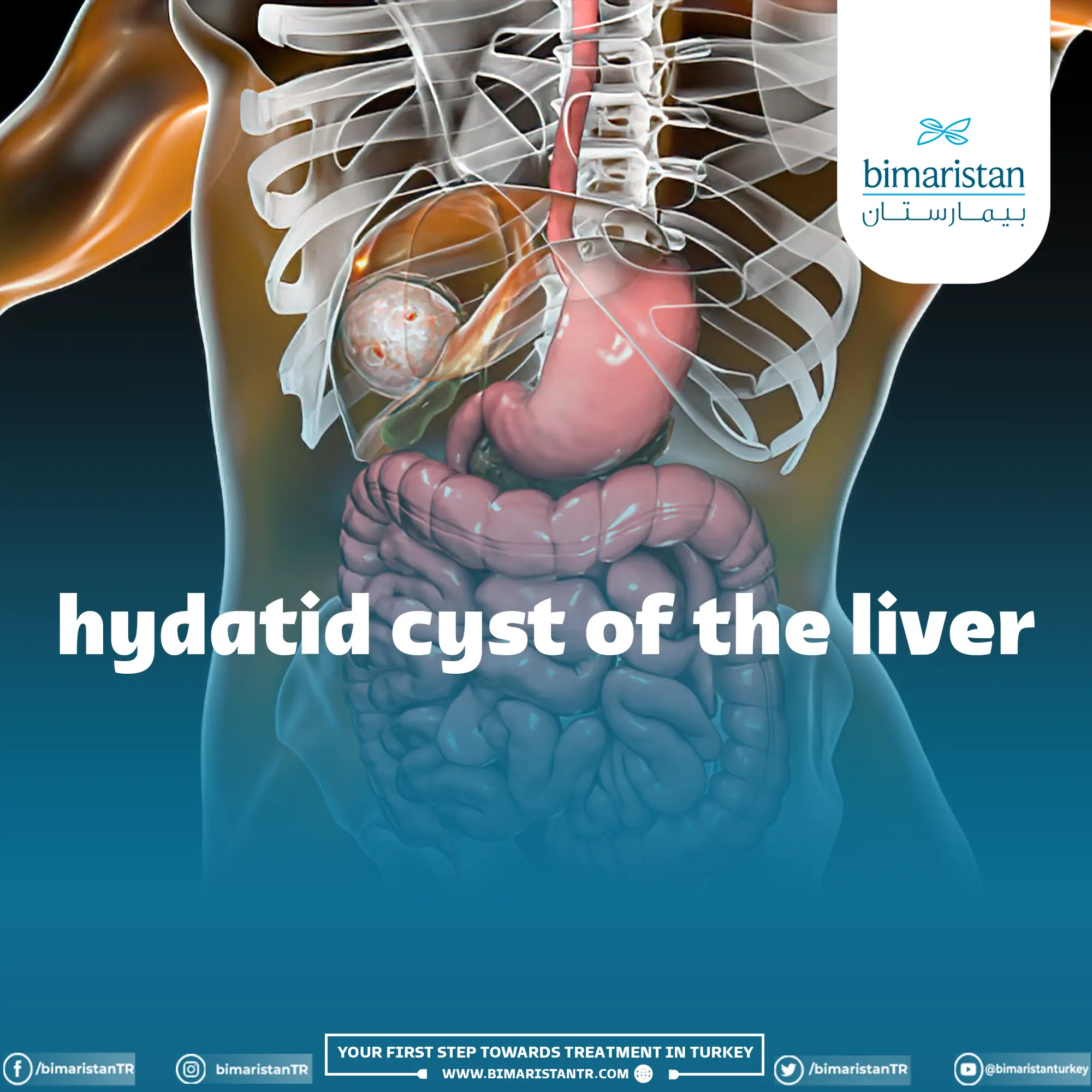 Cover image for the Hydatid Cyst of the Liver article