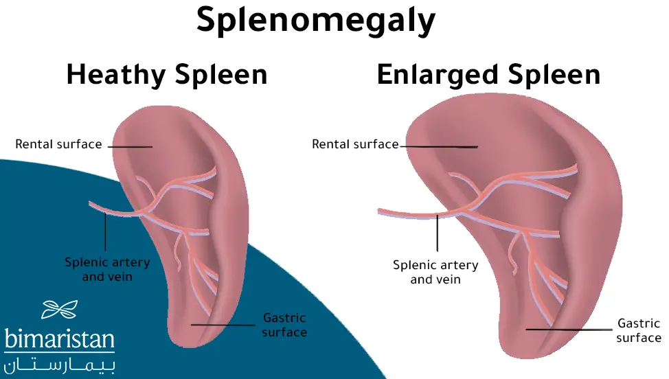 A graphic image showing the difference between a normal spleen and an enlarged spleen