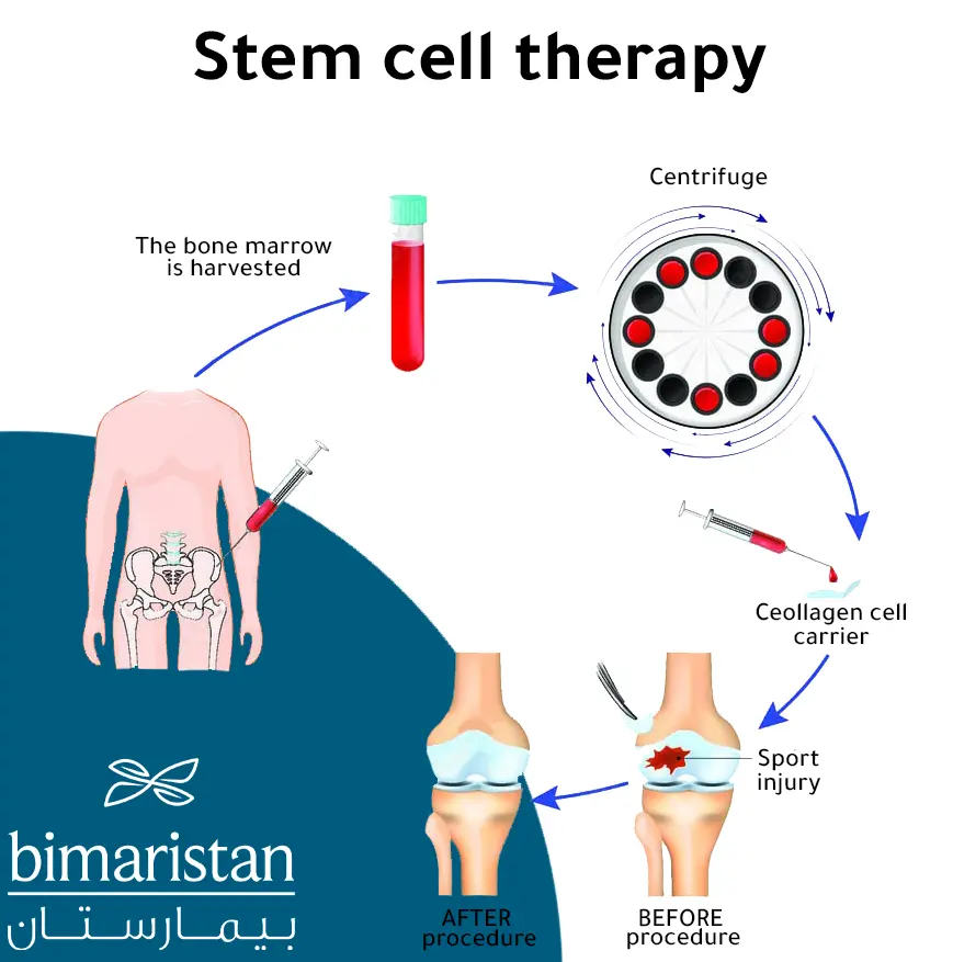 A picture showing how to inject stem cells into the knee