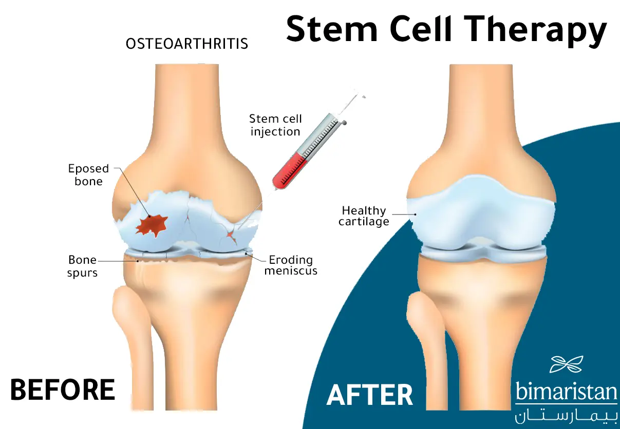 Comparison between the condition of the joint before and after the injection of knee stem cells