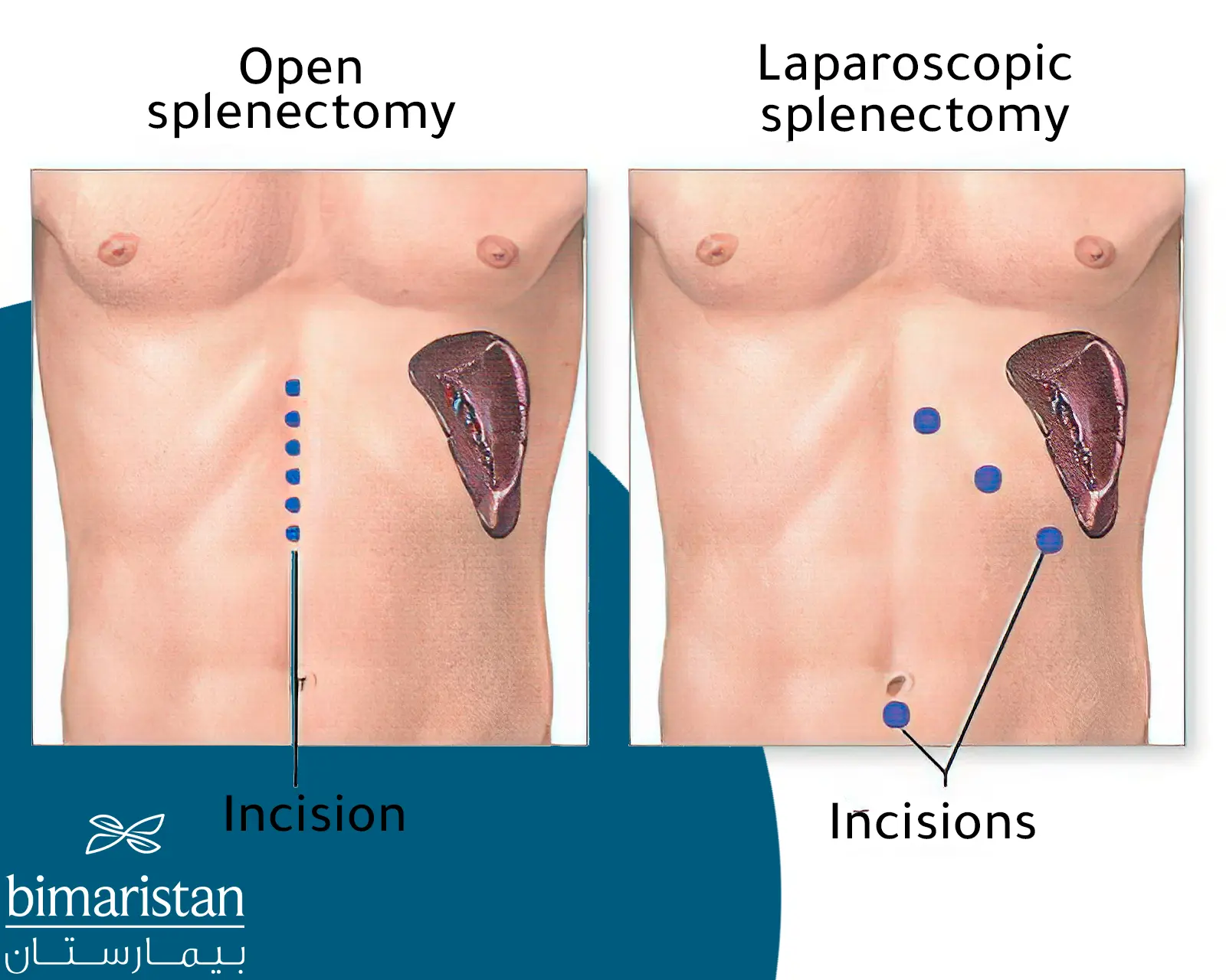 An illustrative image showing the difference between open surgery and laparoscopic surgery in splenectomy