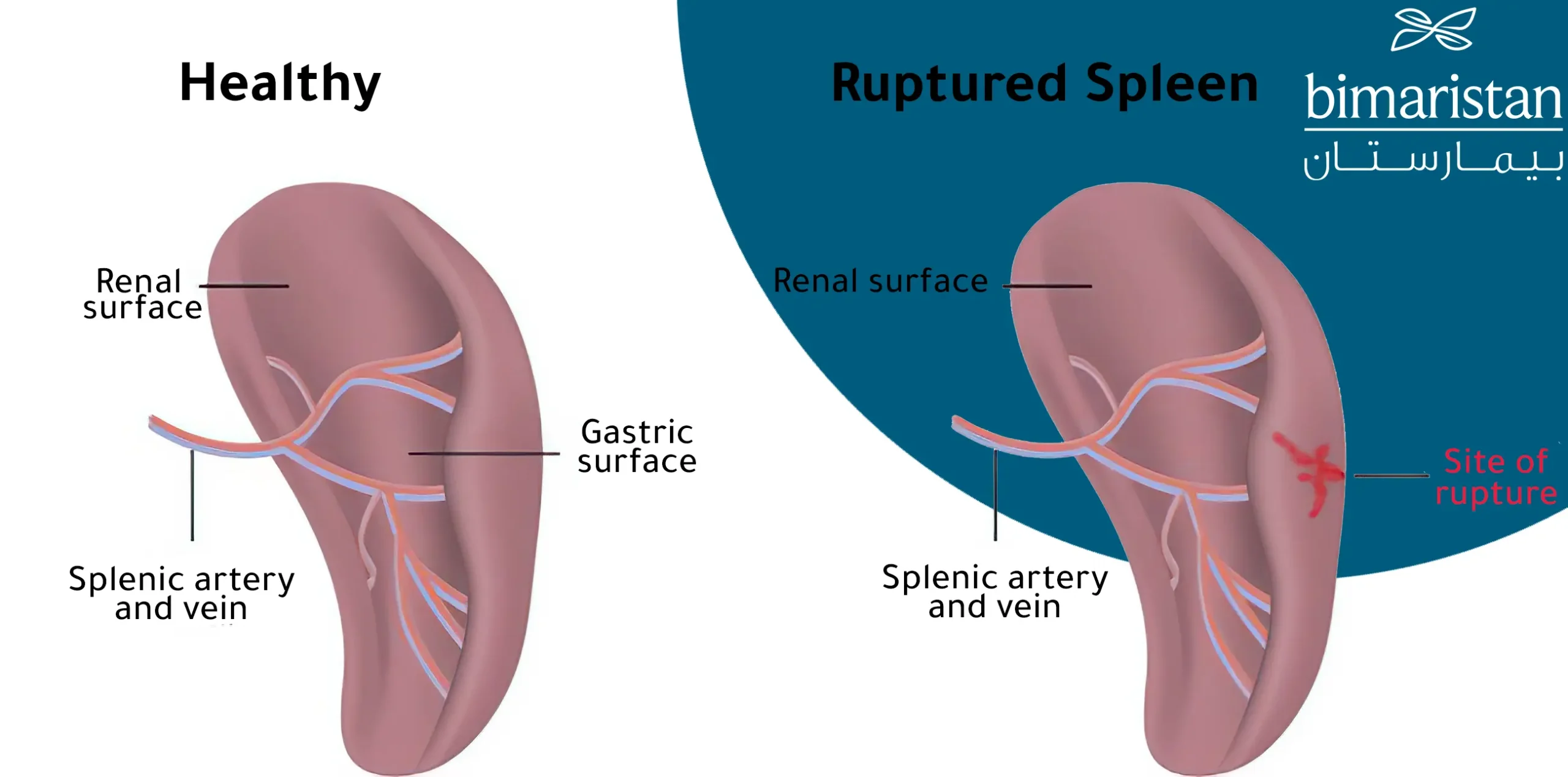 Image showing the difference between a normal spleen and a ruptured spleen
