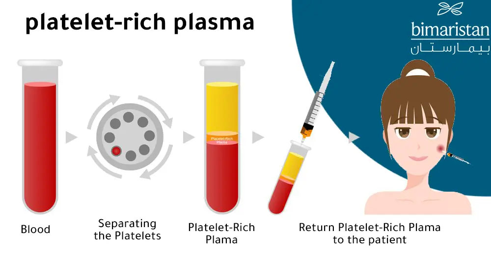 A picture showing how to inject plasma into hair and face