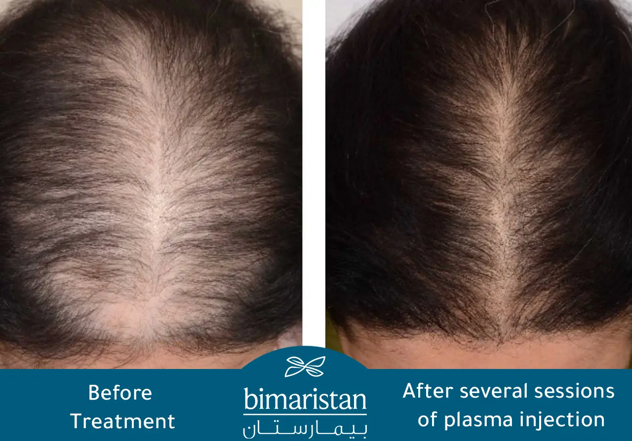Before and after plasma injection for hair and face in Turkey