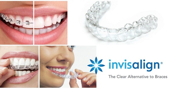 يمكن اعتبار الانفزلاين Invisalign أفضل أنواع تقويم الأسنان الشفاف في تركيا/اسطنبول