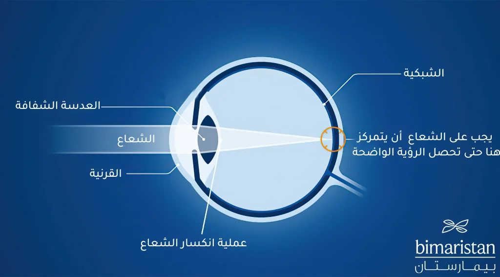 This picture shows the natural vision process and how the beam enters and is refracted until the shadow falls on the retina completely. The LASIK operation in Turkey aims to correct the refraction errors of this ray to give clear and clear vision.
