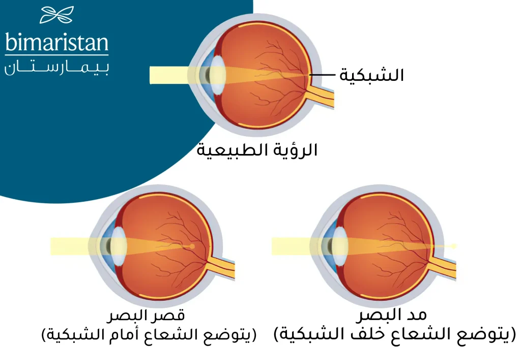 Vision defects that can be corrected through LASIK surgery in Türkiye