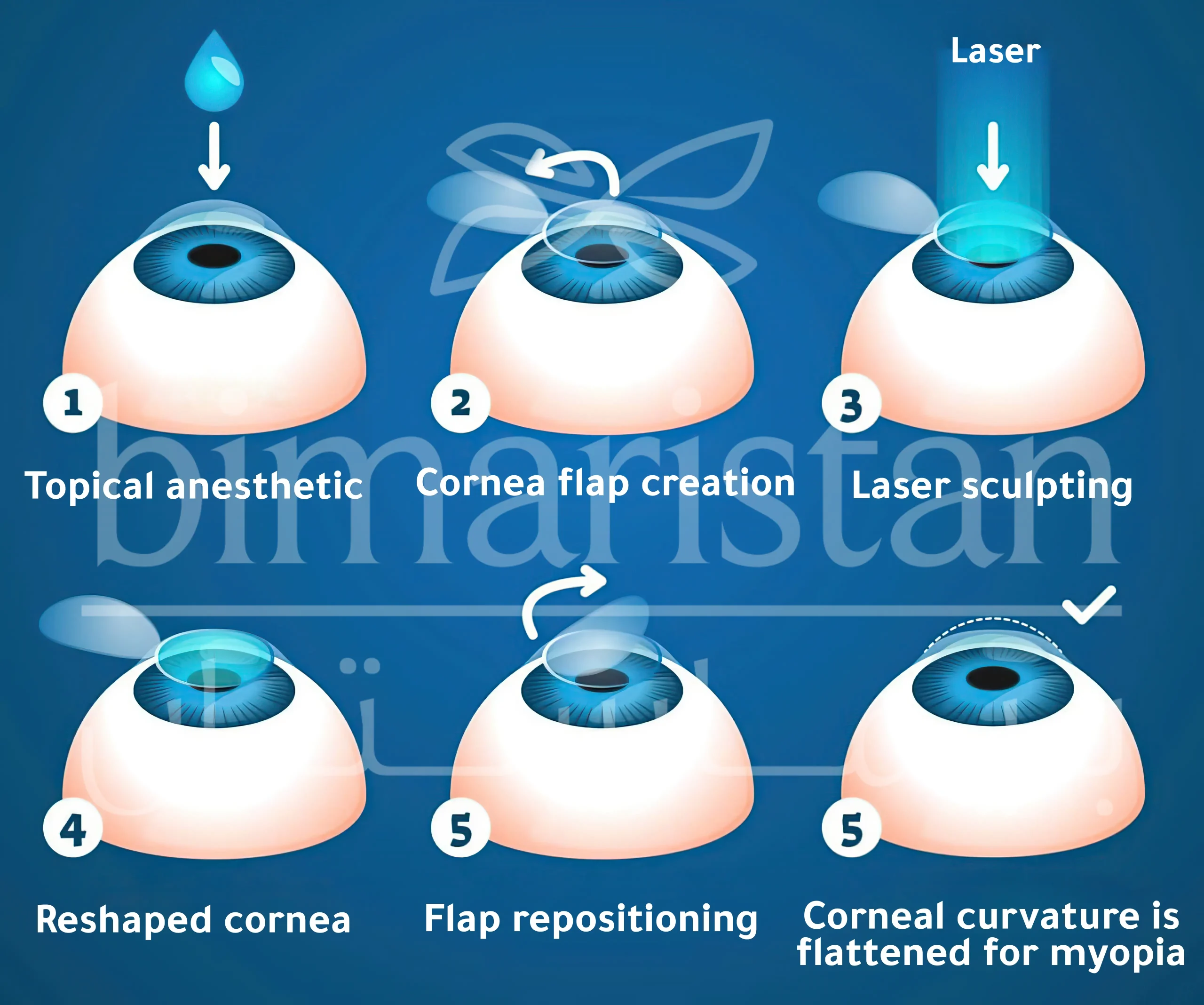 Steps To Perform Lasik Surgery In Turkey.