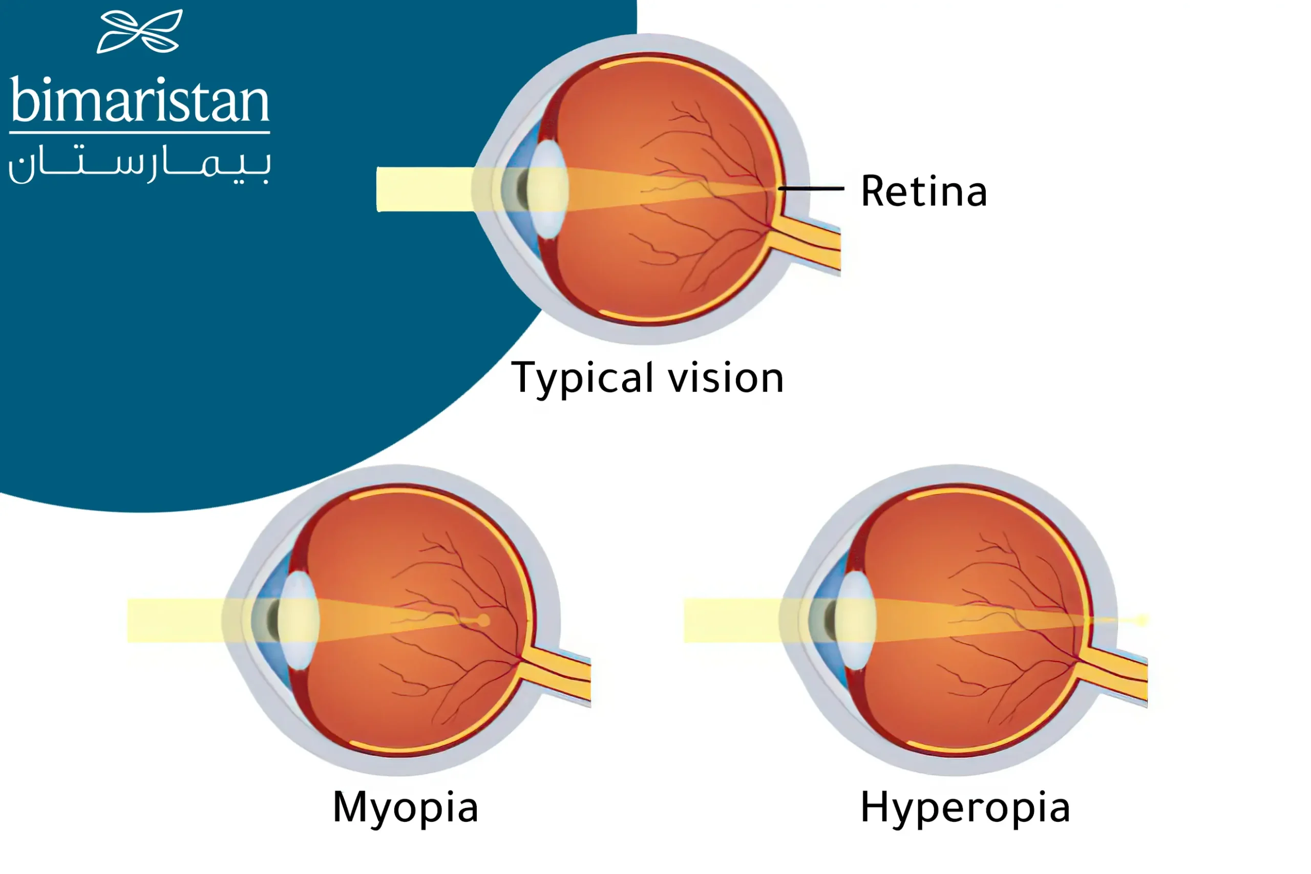 A Picture Showing Vision Defects That Can Be Corrected Through Lasik Surgery In Turkey.