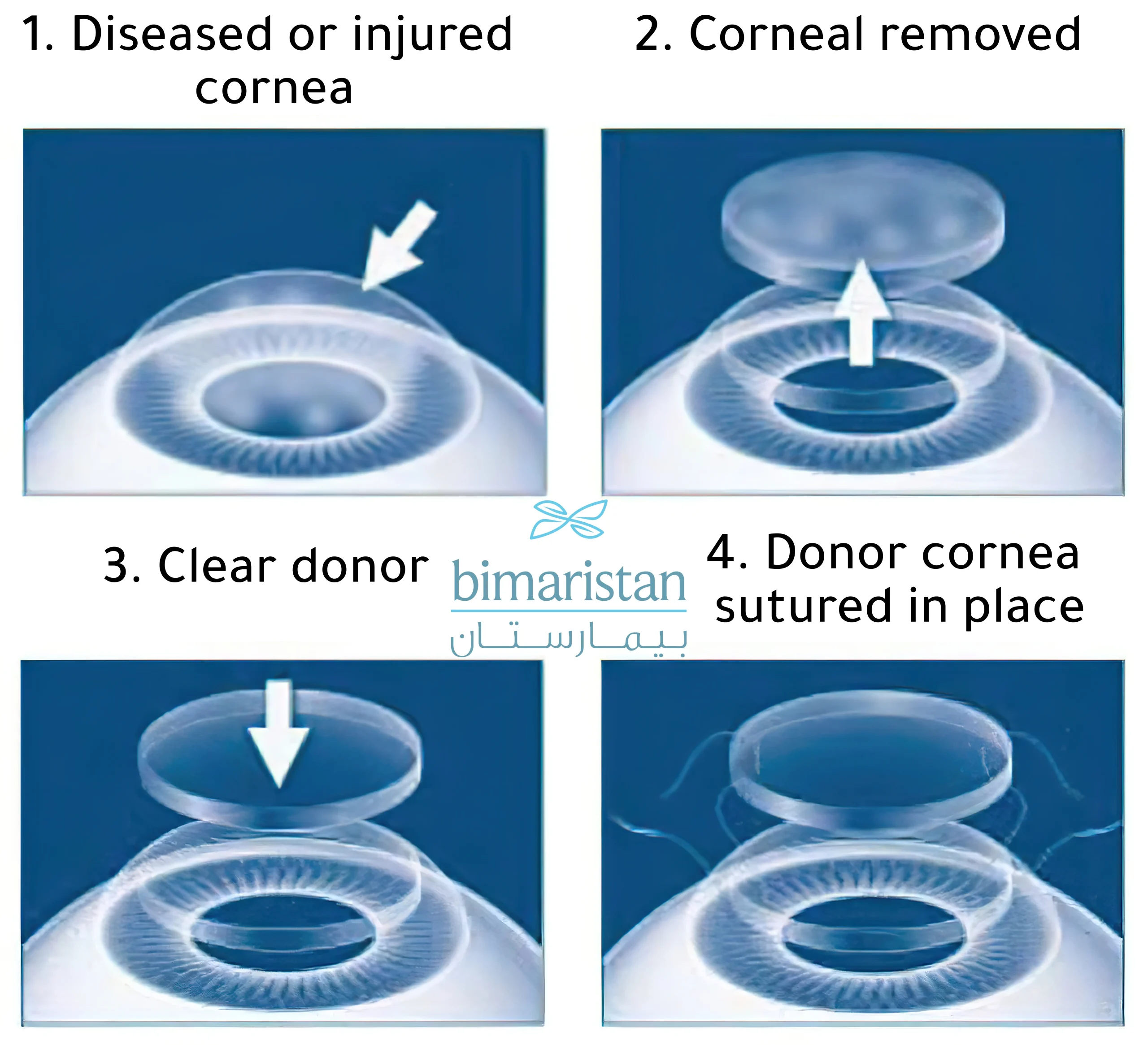 Corneal Transplantation Procedure (Penetrating Keratoplasty)