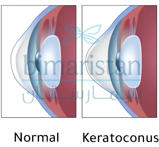 The difference between a healthy cornea and a keratoconus in terms of shape (keratoconus corneal transplantation).