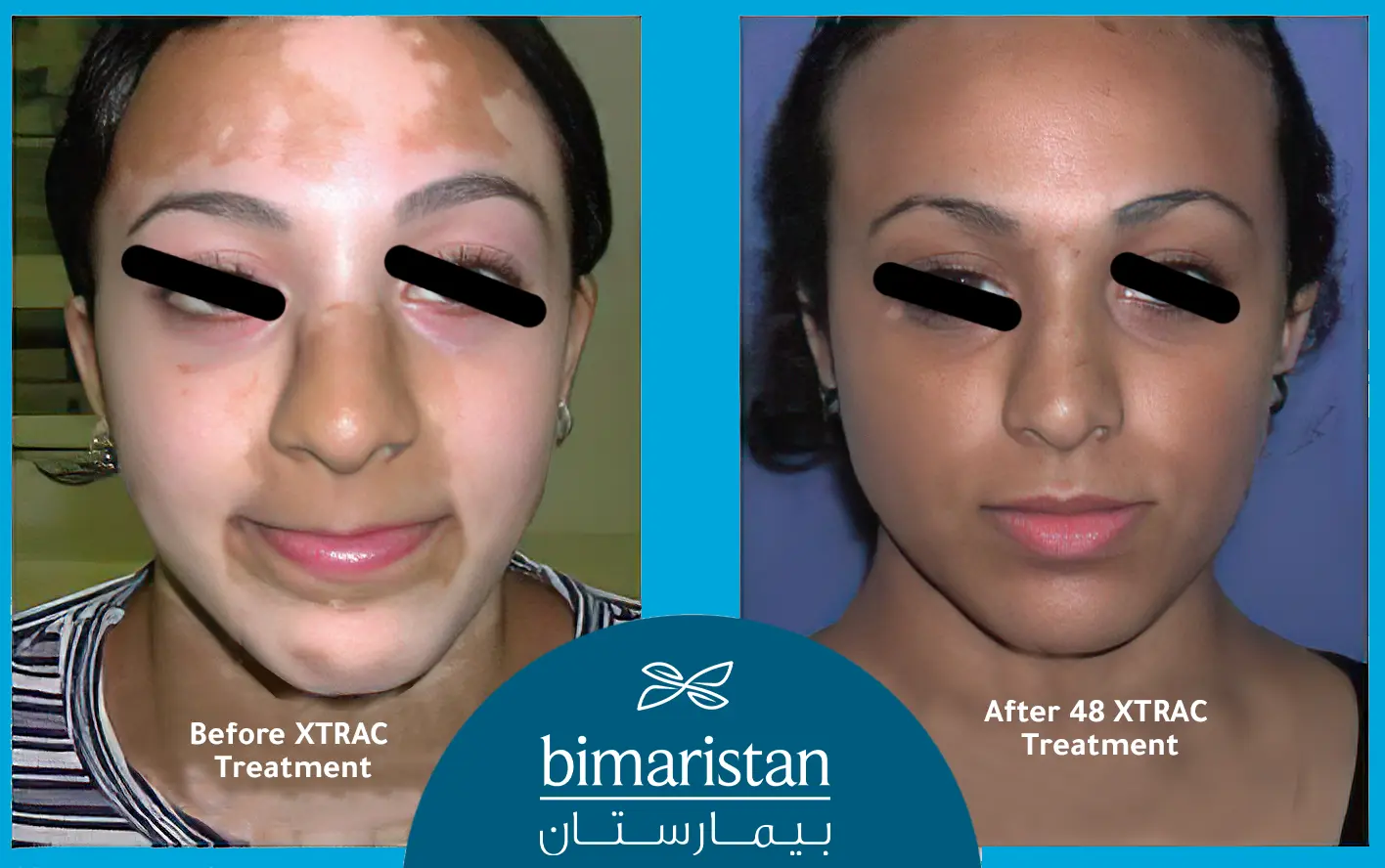 Before and after Vitiligo laser treatment in Türkiye
