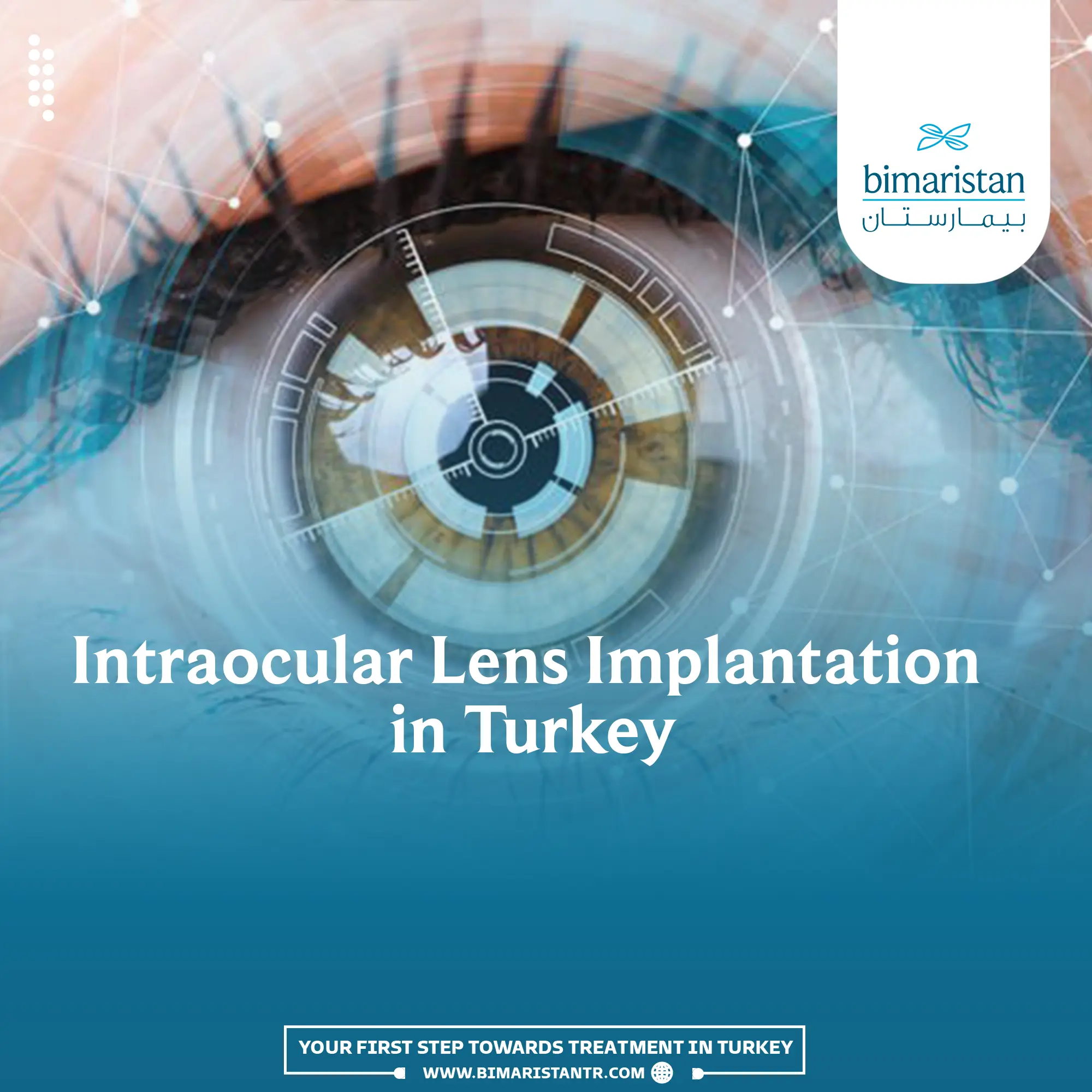 Intraocular Lens Implant in Turkey