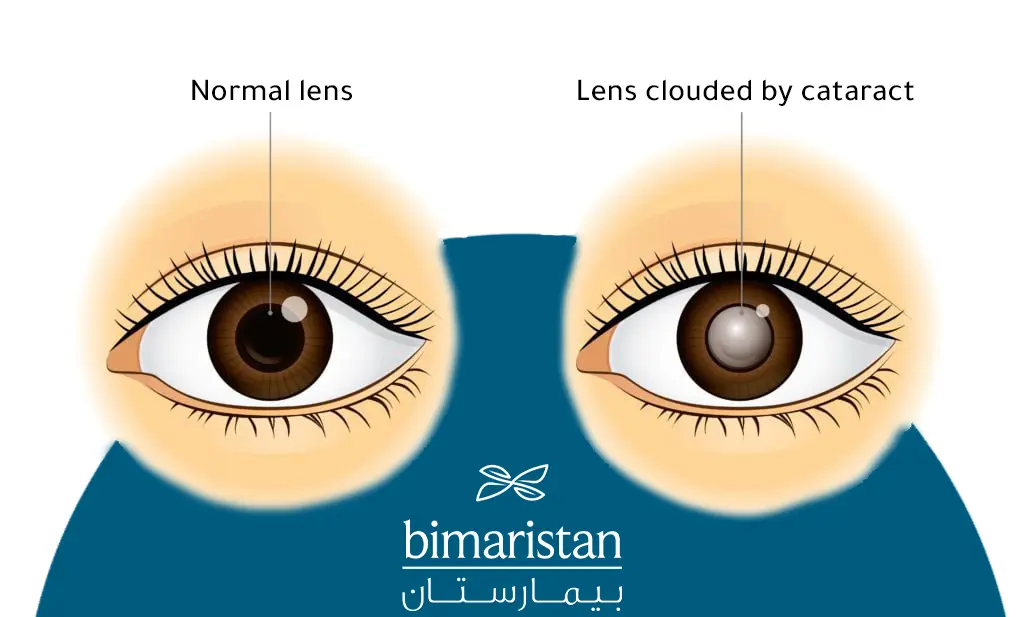 In this picture, we see cataracts which usually require an eye lens transplant to treat it
