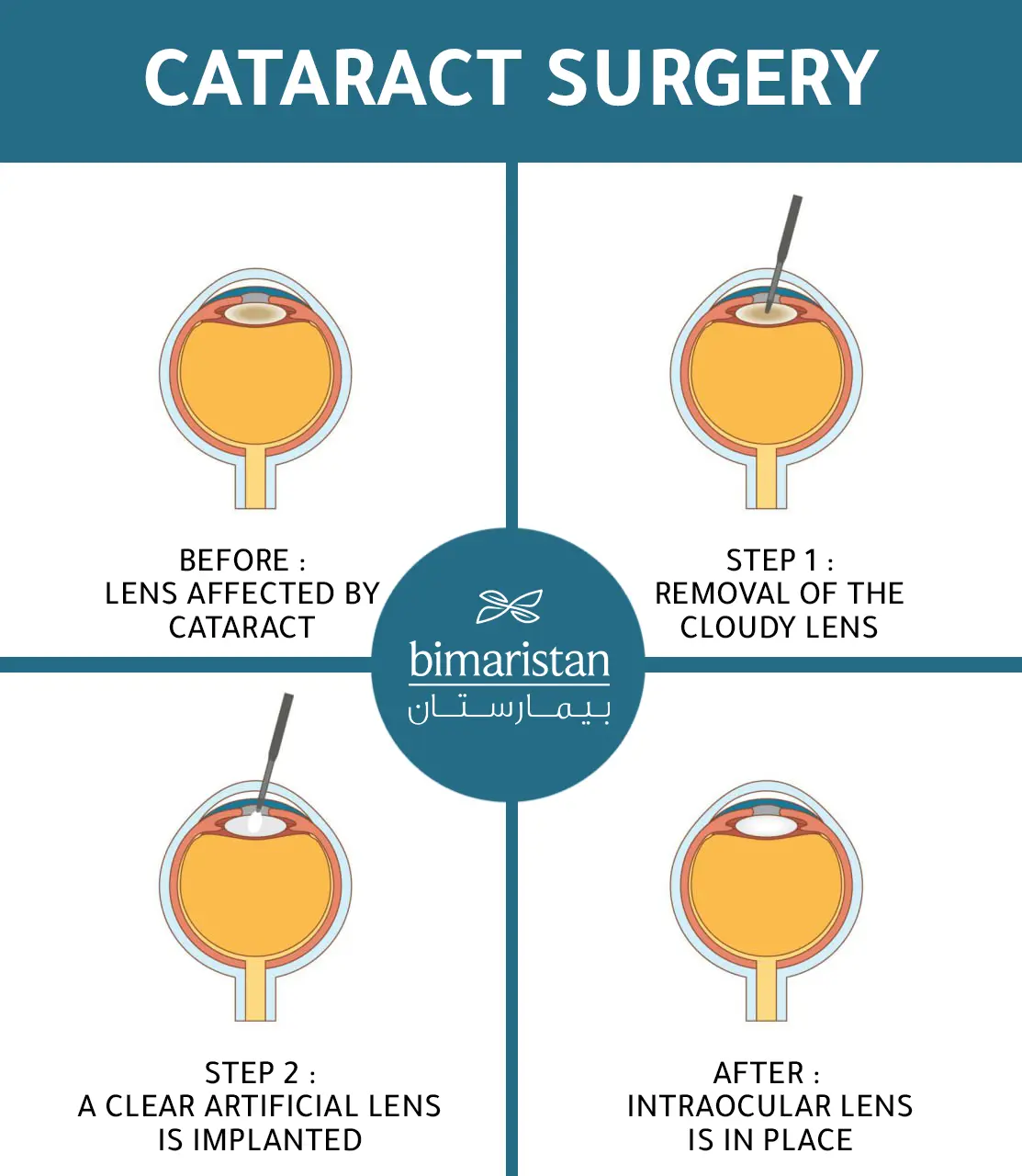 Steps of the Intraocular Lens Implant in Turkey