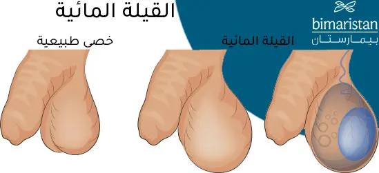 Normal bir skrotum ile testis çevresindeki hidrosel nedeniyle şişmiş skrotum arasındaki farkı gösteren resim