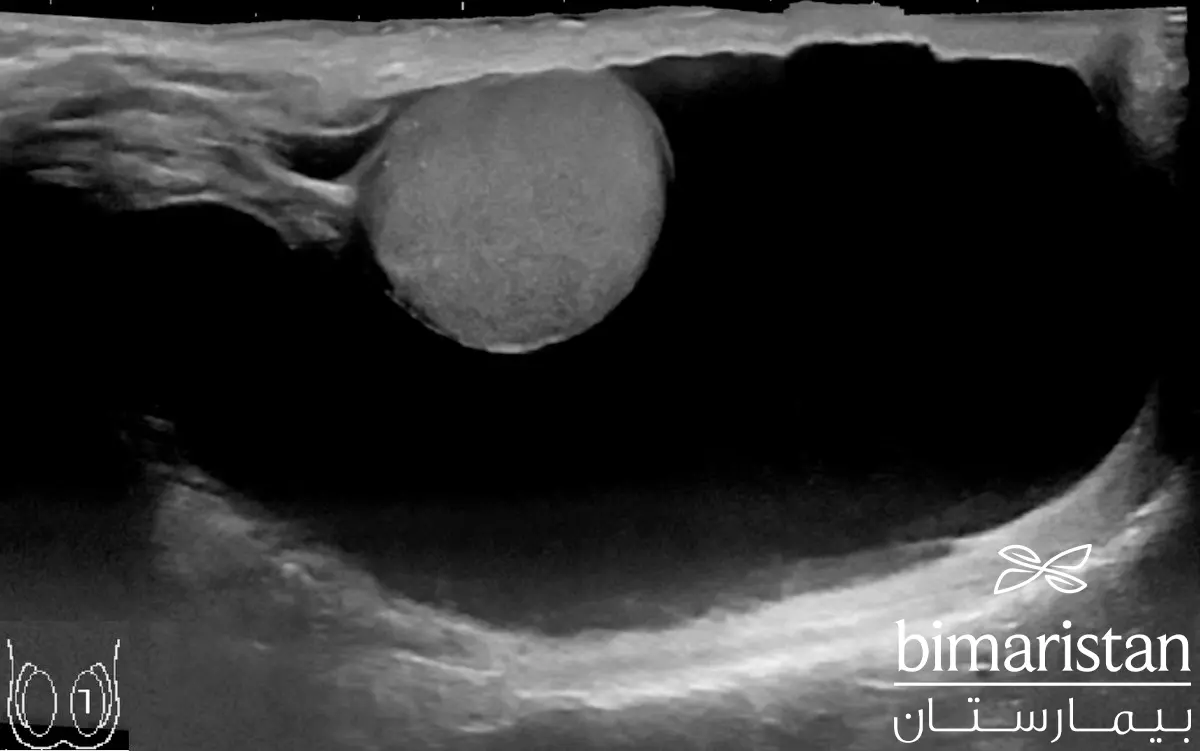 Ultrasound image of fluid around the testicle
