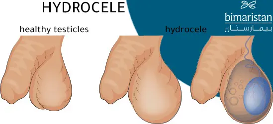 We notice the shape of the hydrocele around the testicle, which causes swelling of the scrotum compared to the normal shape of the scrotum