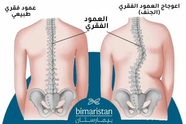 A graphic image showing the difference between a normal spine and a spine affected by scoliosis or scoliosis