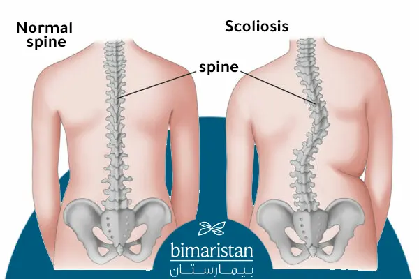 The difference between normal curvature of the spine and scoliosis of the spine
