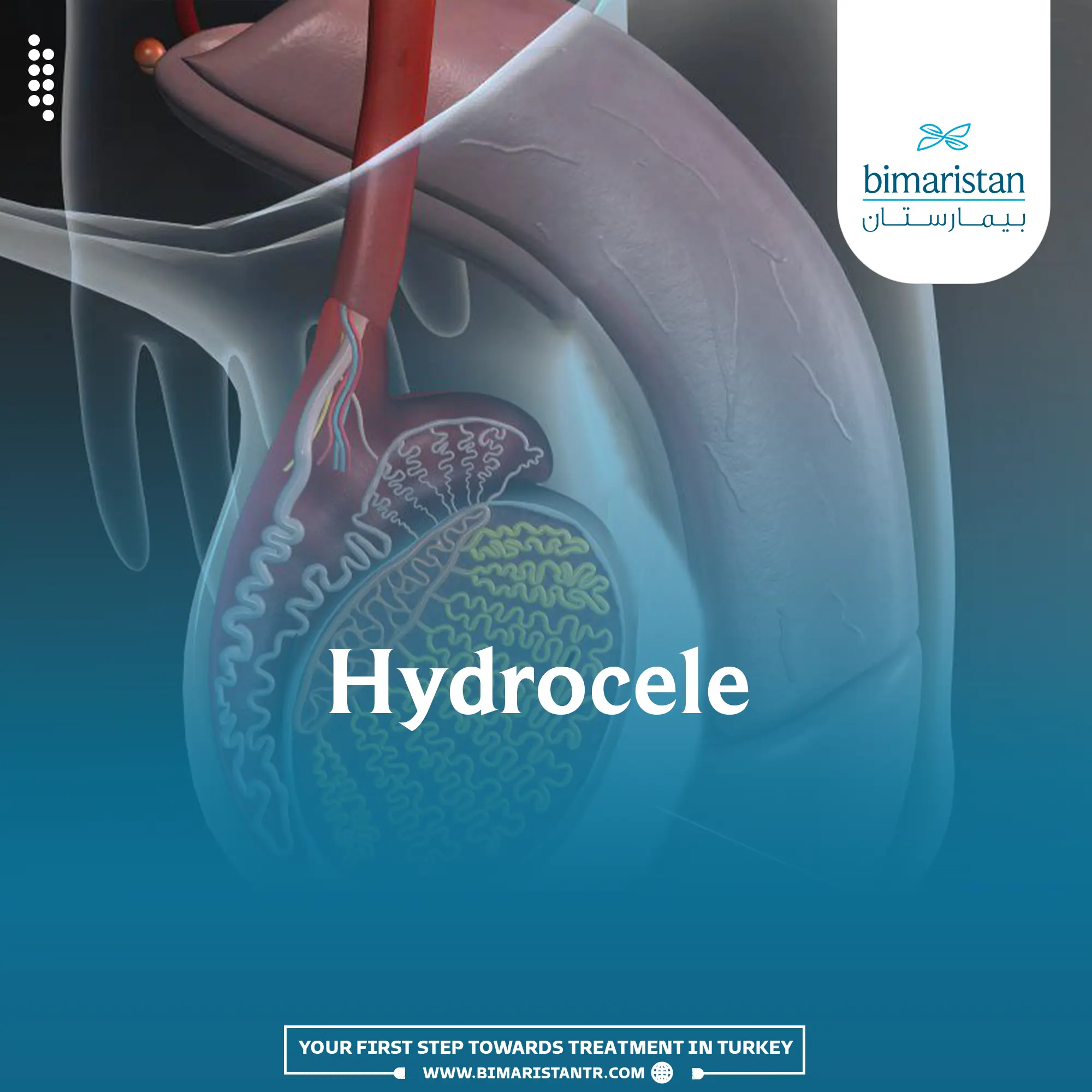 Picture of a testicular hydrocele