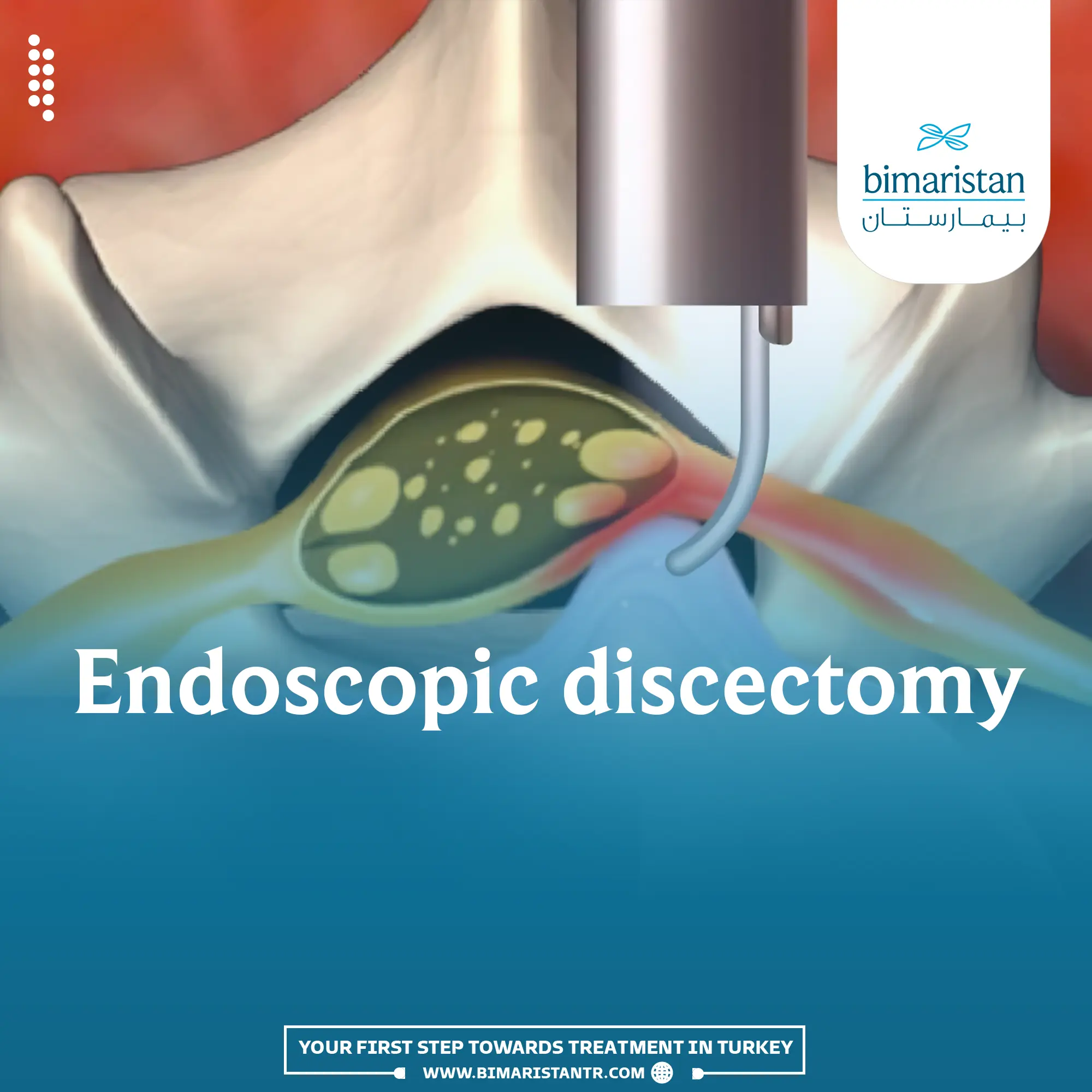 Endoscopic Discectomy and its advantages in Turkey