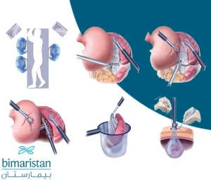 Steps of surgical removal of spleen in Turkey