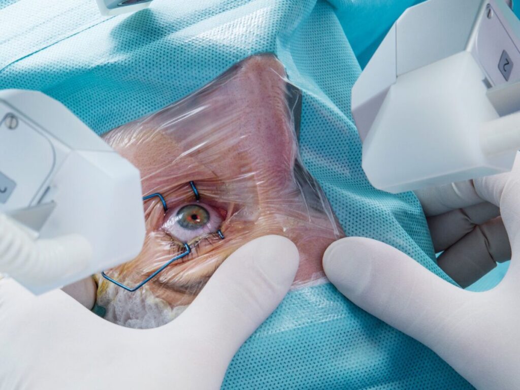 During a corneal transplant without stitches
