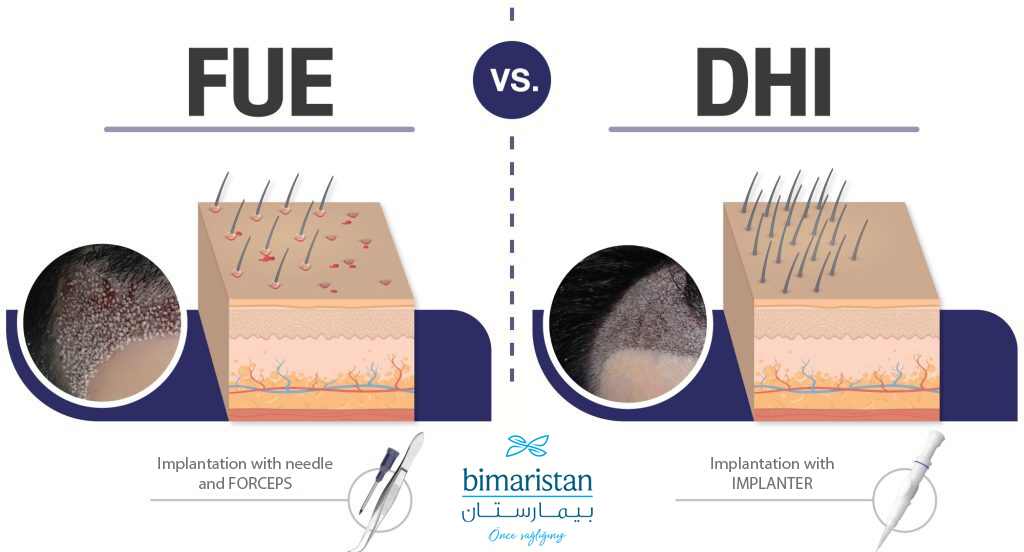 A graphic showing the difference between the FUE technique and the DHI technique in terms of the number of transplanted grafts and the tools used