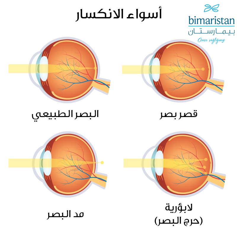 صورة توضح أسواء الإنكسار المسببة لمرض ضبابية العين