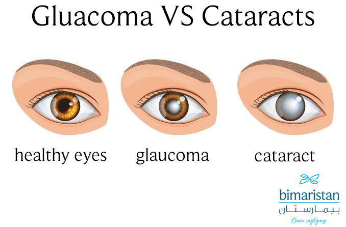 An Image Showing The Difference Between Cataract And Glaucoma In The Eye