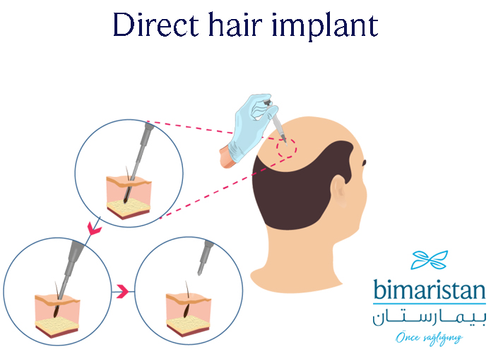 A graphic image showing the steps of direct hair transplantation with a Choi pen