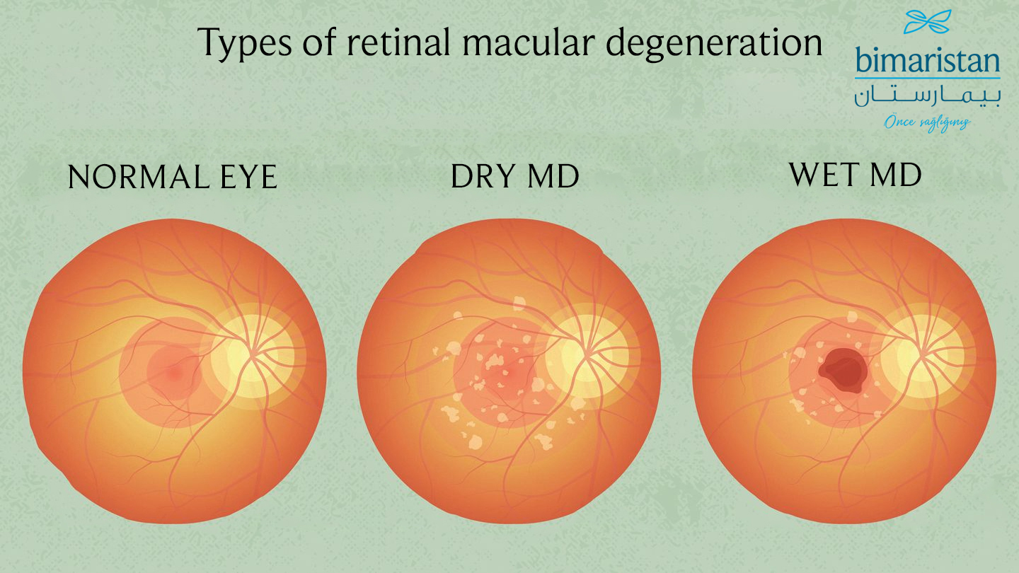 Image Illustrating Macular Degeneration Of The Retina Causing Blurry Eye Disease In The Elderly