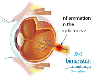 Image Showing Optic Neuritis Behind The Eyeball