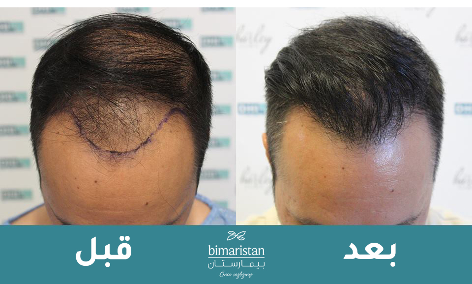 صورة توضح الفرق لمريض قبل وبعد إجراء عملية زراعة الشعر بتقنية DHI. 
