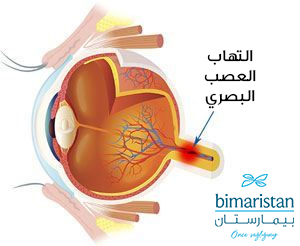 صورة توضح التهاب العصب البصري خلف مقلة العين