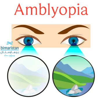 Image Showing Amblyopia (Lazy Eye), Which Is One Of The Causes Of Blurry Vision In Children