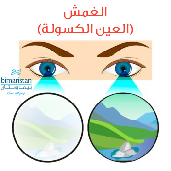 صورة توضح الغمش (العين الكسولة) وهي من أسباب ضبابية الرؤية عند الصغار