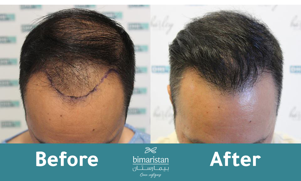 A picture showing the difference for a patient before and after a hair transplant using the DHI technique. 