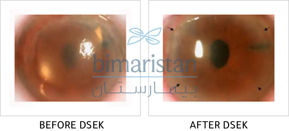 A picture showing the cornea before and after a sutureless corneal transplant (DSEK), which targets the endothelium, Descemet's membrane, and part of the stromal tissue.