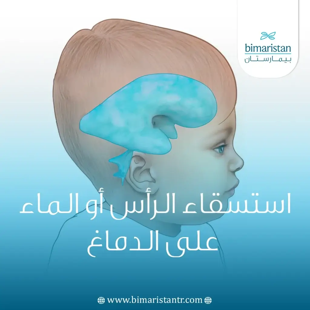 علاج استسقاء الرأس (ماء الدماغ) في تركيا