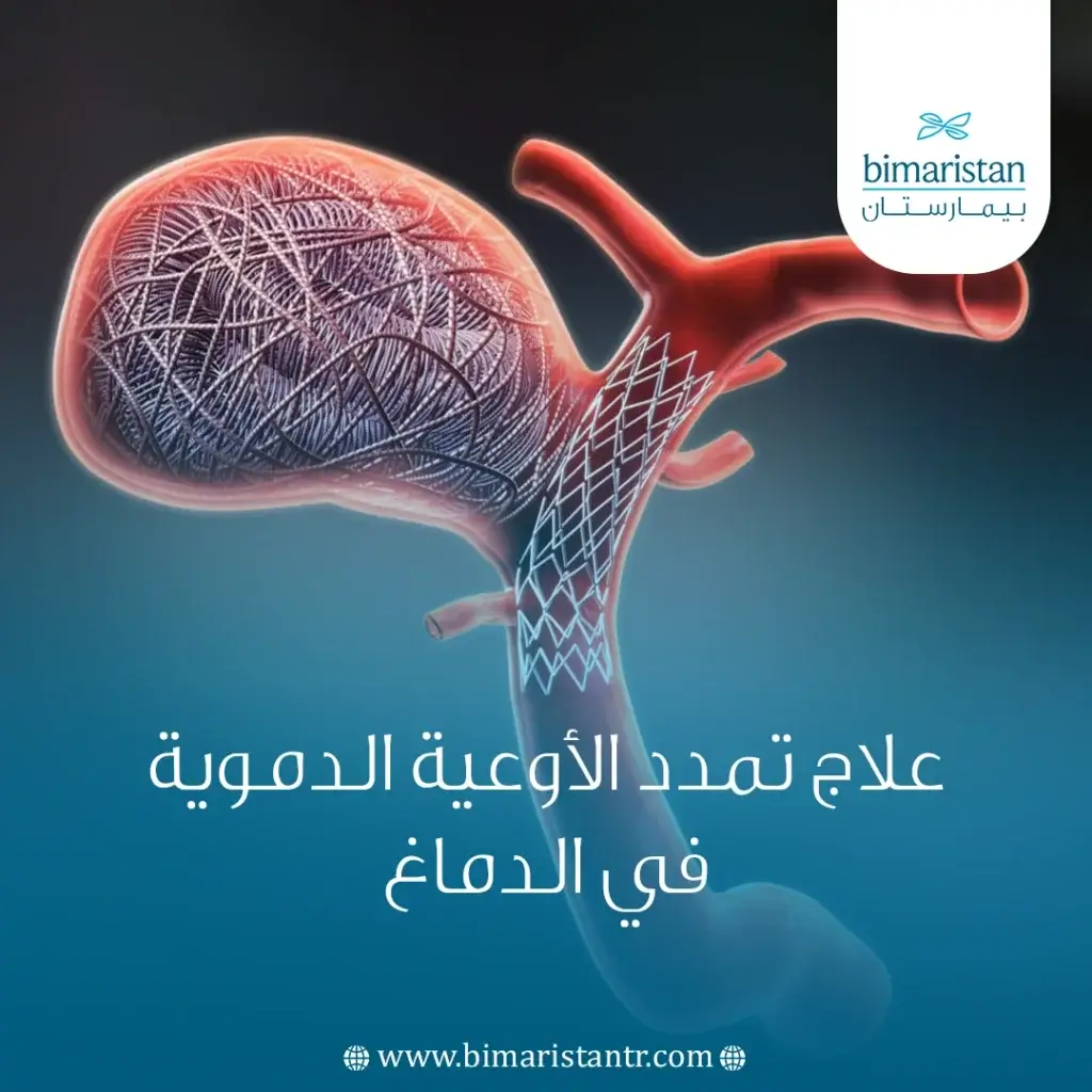 اللف داخل الأوعية الدموية_ علاج تمدد الأوعية الدموية في الدماغ